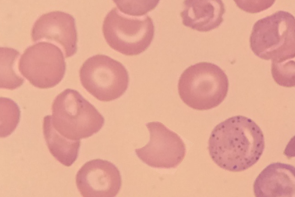 Red Blood Cell Morphology: Bite Cell thumbnail