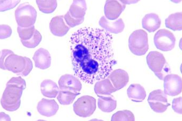 White Blood Cell Inclusions: Toxic Granulation thumbnail
