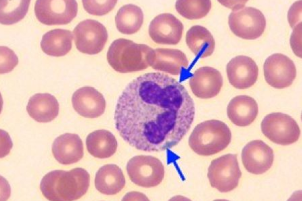 White Blood Cell Inclusions: Döhle Body thumbnail