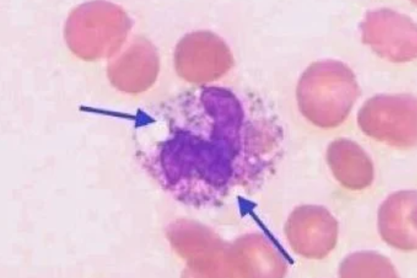 White Blood Cell Inclusions: Toxic Vacuolation thumbnail