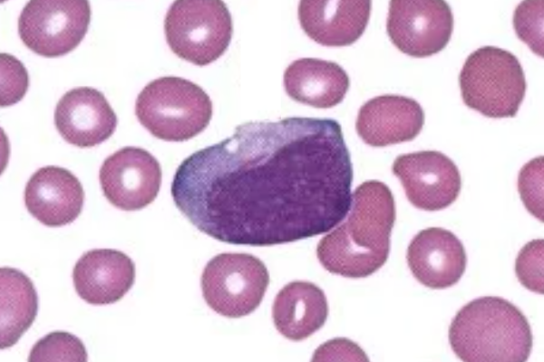 White Blood Cell Inclusions: Auer Rod thumbnail