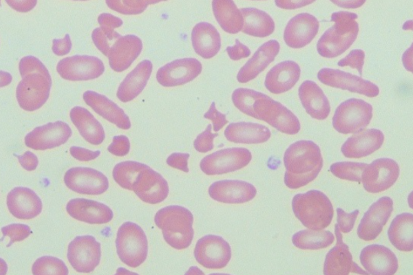 Red Blood Cell Morphology: Schistocyte thumbnail