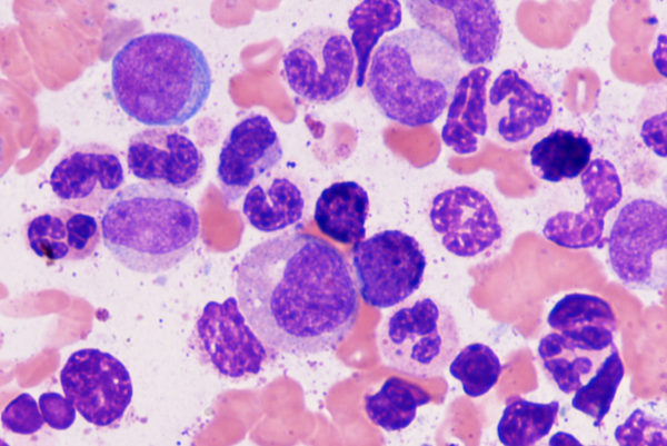 Chronic Myeloid Leukemia thumbnail