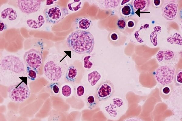 Myelodysplastic Neoplasms thumbnail