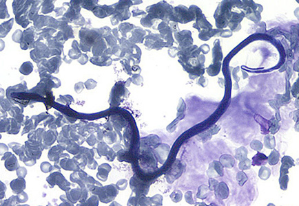 Parasitology Spotlight: Loa loa thumbnail