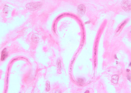 Parasitology Spotlight: Onchocerca volvulus thumbnail