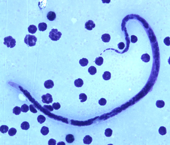 Parasitology Spotlight: Lymphatic Filariasis thumbnail