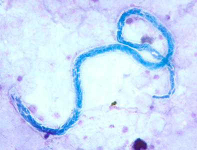 Parasitology Spotlight: Mansonellosis thumbnail