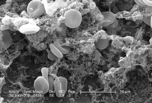 Coagulation Case Studies: Curious, Complex, and Compelling thumbnail