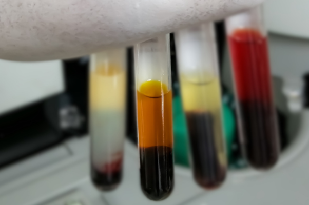 Hematology Interfering Factors: Icterus thumbnail