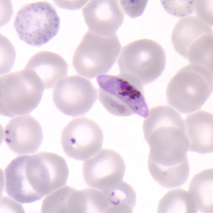 Parasitology Spotlight: Malaria thumbnail