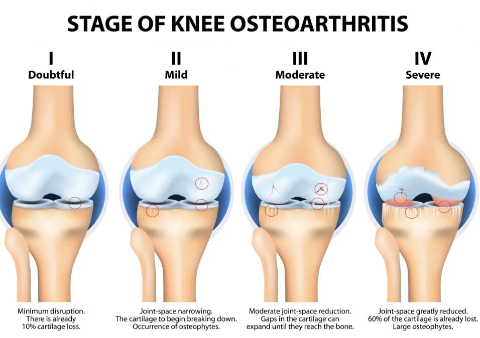 Non Surgical Knee Pain