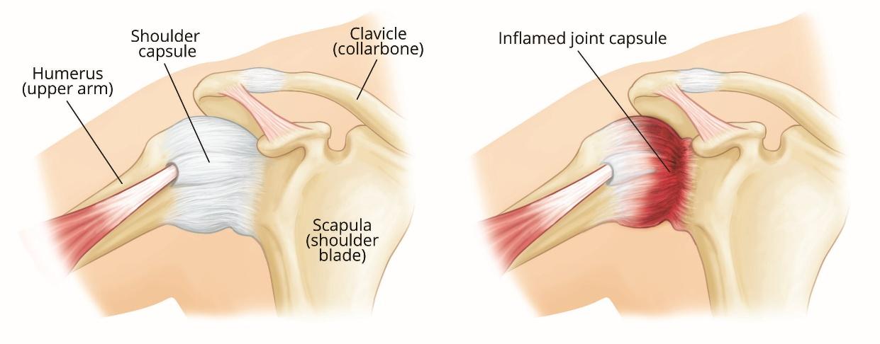 Frozen Shoulder - Adhesive Capsulitis - OrthoInfo - AAOS