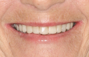 Smile Gallery