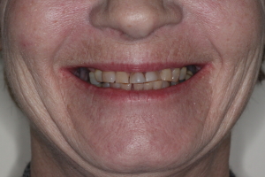 Smile Gallery