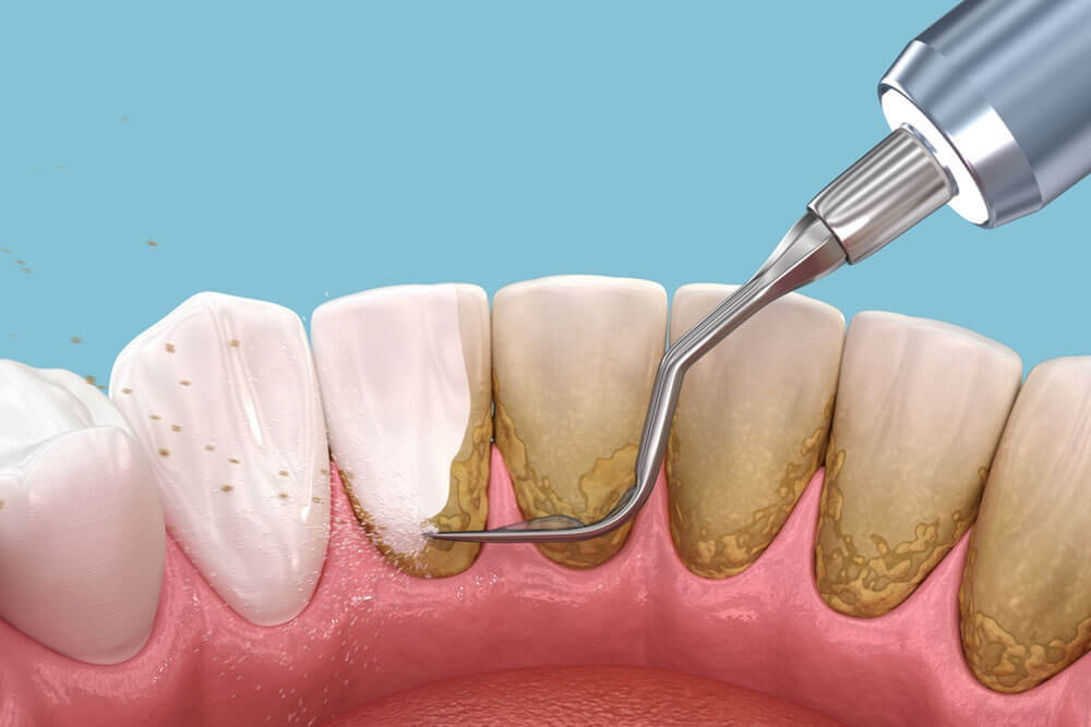 Dental Exams and Cleanings