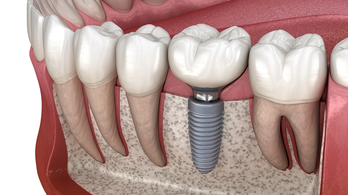How Can Dental Implants Restore Your Natural Smile
