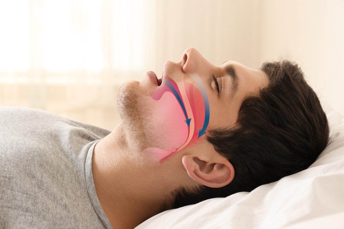 Sleep Apnea