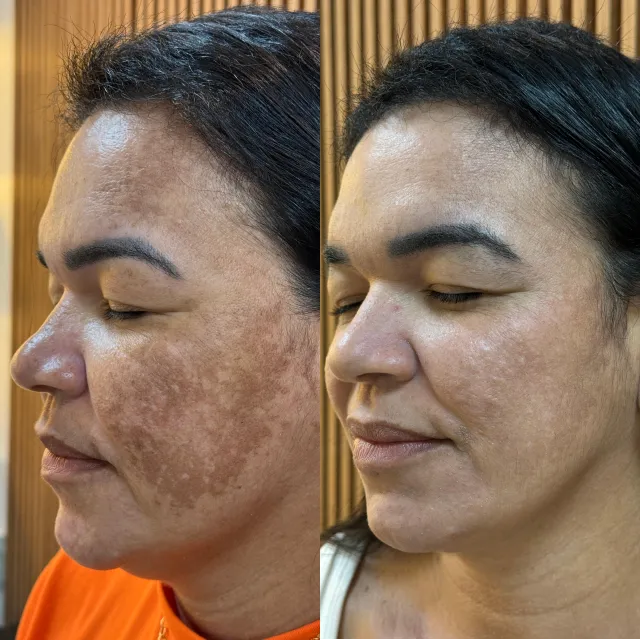 Resultado antes/depois do Peeling.