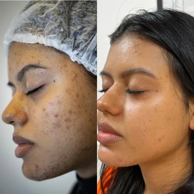 Resultado antes/depois do Peeling.