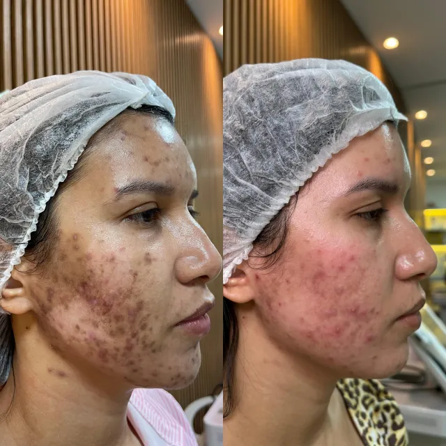 Imagem de antes e depois do Peeling.