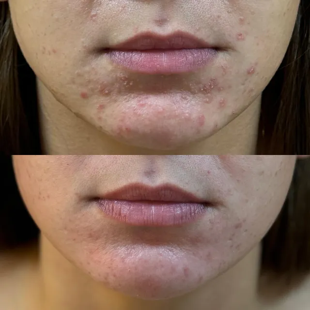 Imagem de antes e depois do Peeling.