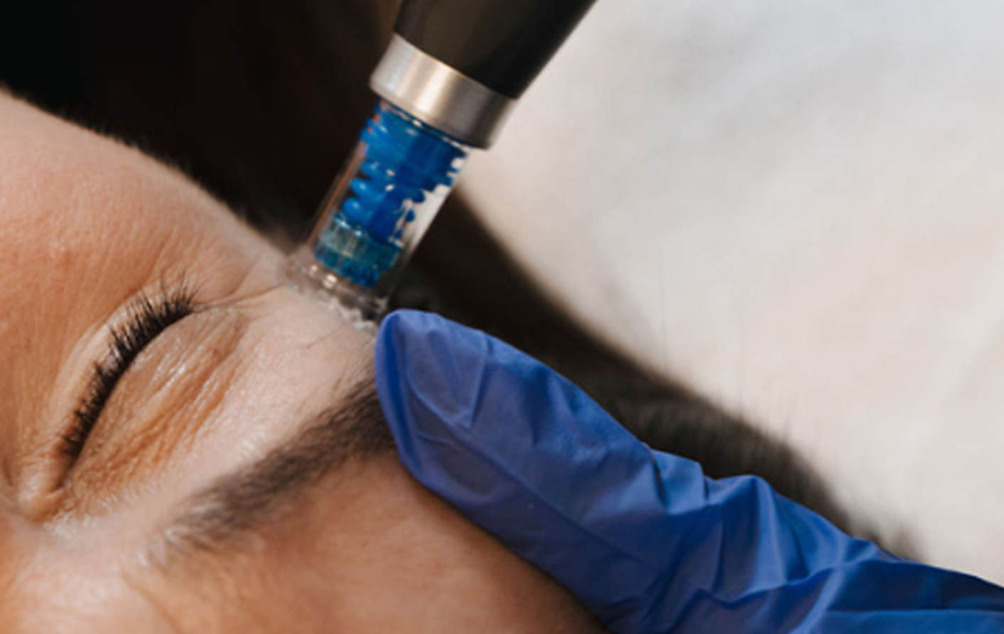 Nærmynd af Dermapen microneedling meðferð sem örvar kollagenframleiðslu og dregur úr fínum línum, framkvæmd af hjúkrunarfræðingi á Húðfegrun.