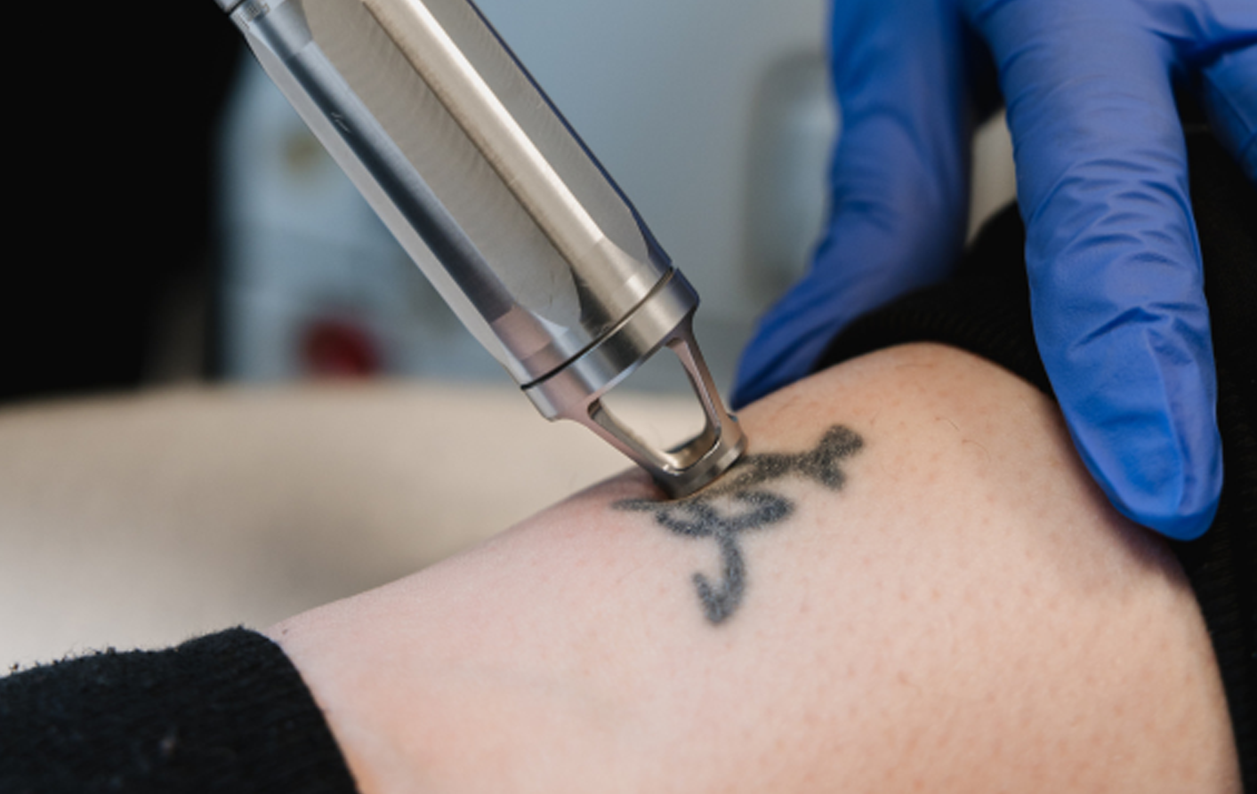 Lasermeðferð sem notar mismunandi bylgjulengdir til að brjóta niður tattoo liti og fjarlægja tattoo á öruggan hátt.