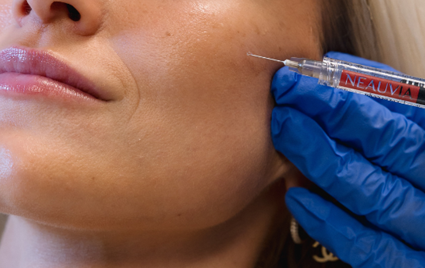 Mesotherapy meðferð sem sprautar Hyaluronic sýru og örvar kollagenframleiðslu fyrir þéttari, stinnari og rakameiri húð.