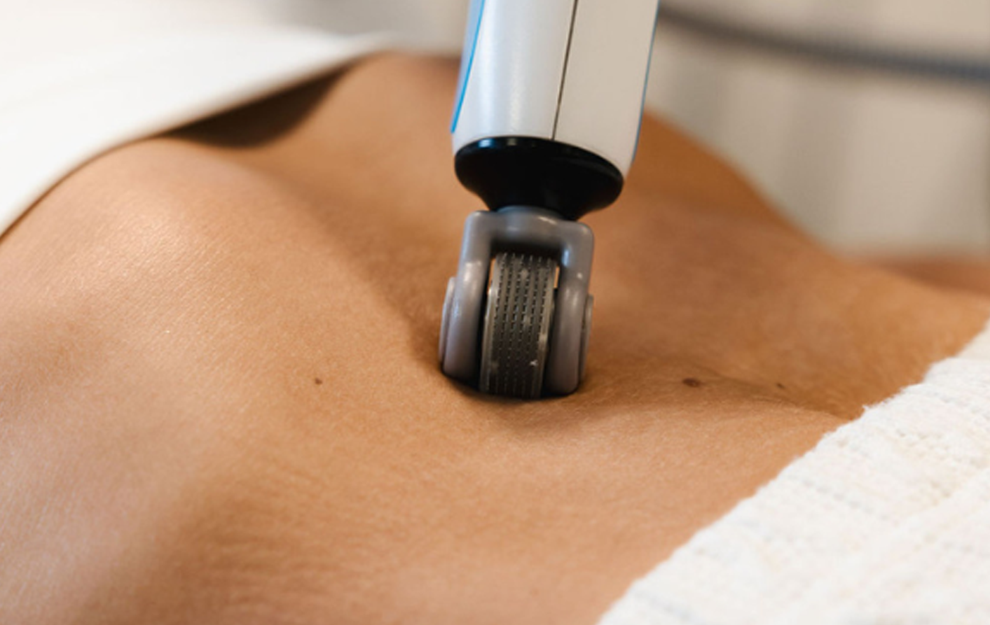 RF microplasma meðferð sem vinnur á örum og húðslitum, jafnar áferð og bætir teygjanleika húðarinnar.