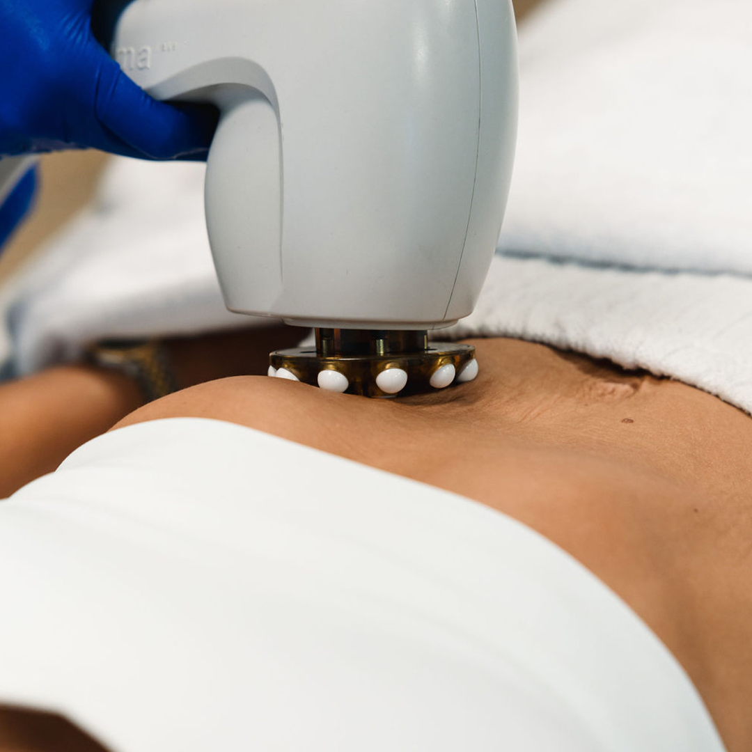 Hjúkrunarfræðingur hjá Húðfegrun framkvæmir Skin Tightening á maga með háþróaðri laser- og RF-tækni. Meðferð sem styður áhrif Hyaluronic Acid Booster. Fáðu stinnari húð – bókaðu meðferð í klínísku umhverfi Húðfegrunar.