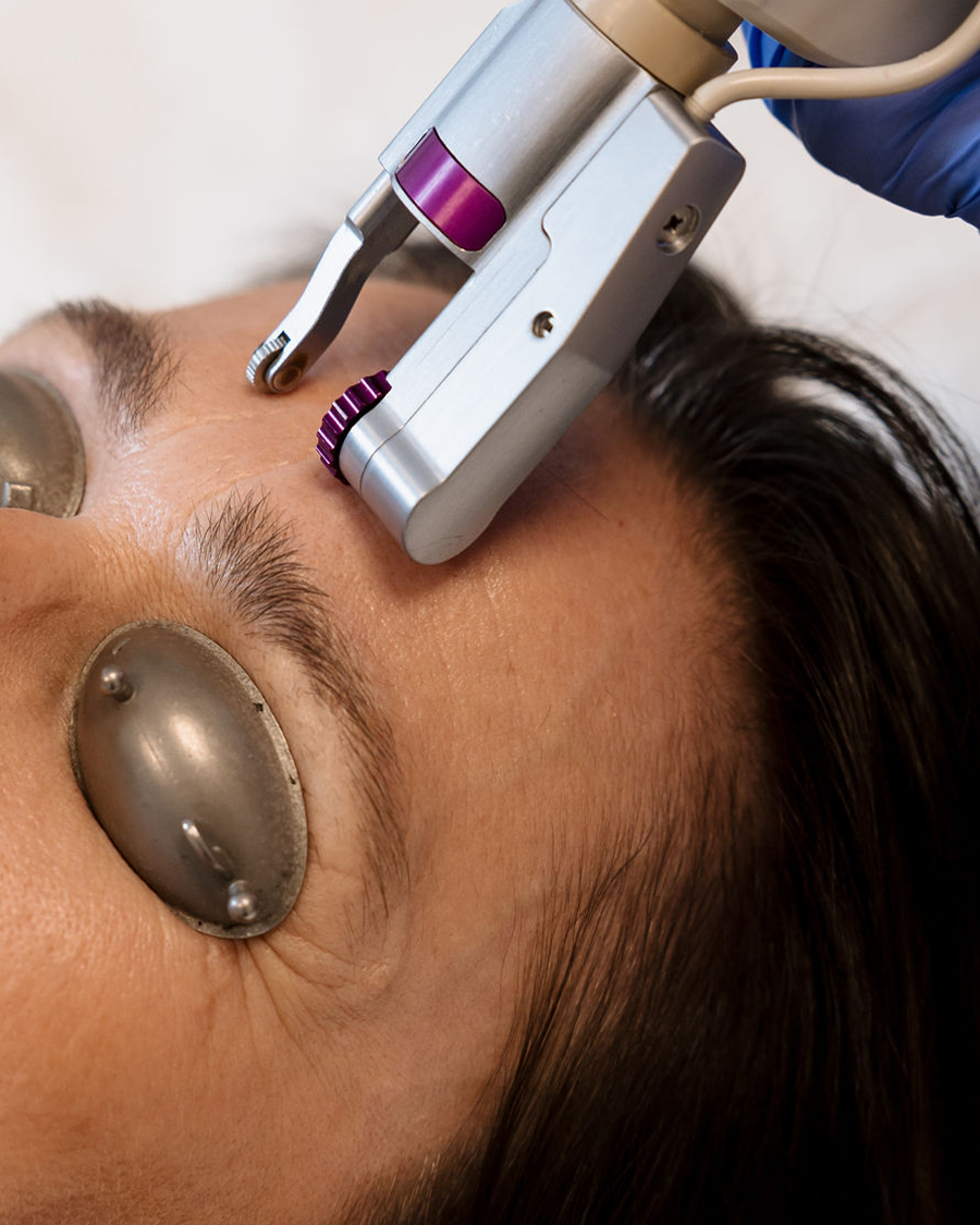 Nærmynd af enni þar sem hjúkrunarfræðingur hjá Húðfegrun framkvæmir Erbium YAG Laser meðferð. Öflug lasermeðferð sem endurnýjar húð og jafnar áferð á öruggan hátt. Bókaðu meðferð á klínísku húðstofunni í Reykjavík.