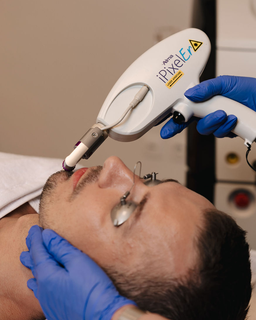 Hjúkrunarfræðingur hjá Húðfegrun framkvæmir Erbium YAG Laser á karlmanni í afslöppuðu og faglegu klínísku umhverfi. Meðferðin þéttir húð, vinnur á línum og gefur jafnan húðlit. Bókaðu tíma hjá sérfræðingum okkar í Reykjavík.