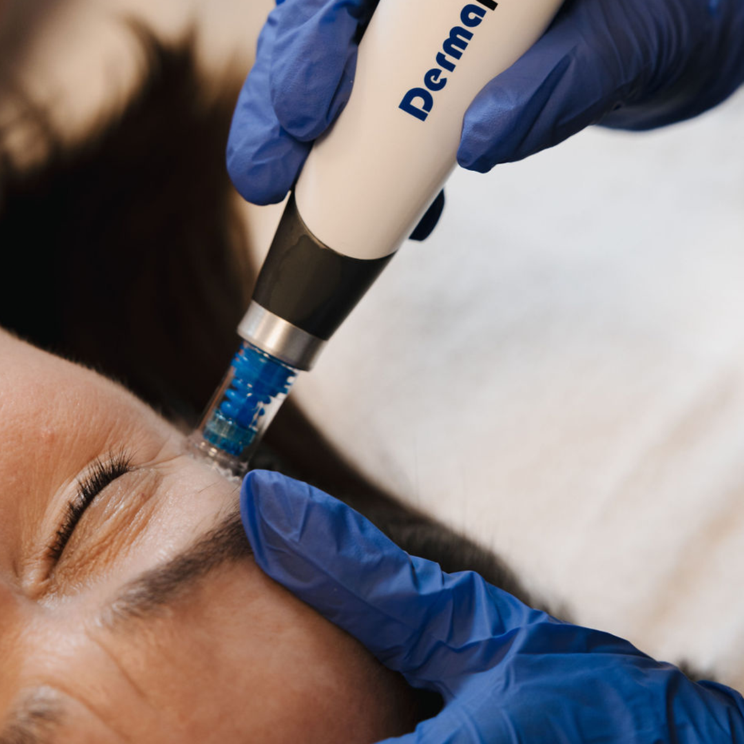 Hjúkrunarfræðingur hjá Húðfegrun framkvæmir Dermapen microneedling til að minnka ör og jafna áferð húðar. Meðferðin örvar kollagenframleiðslu og bætir húðgæði. Bókaðu faglega húðmeðferð í Reykjavík.