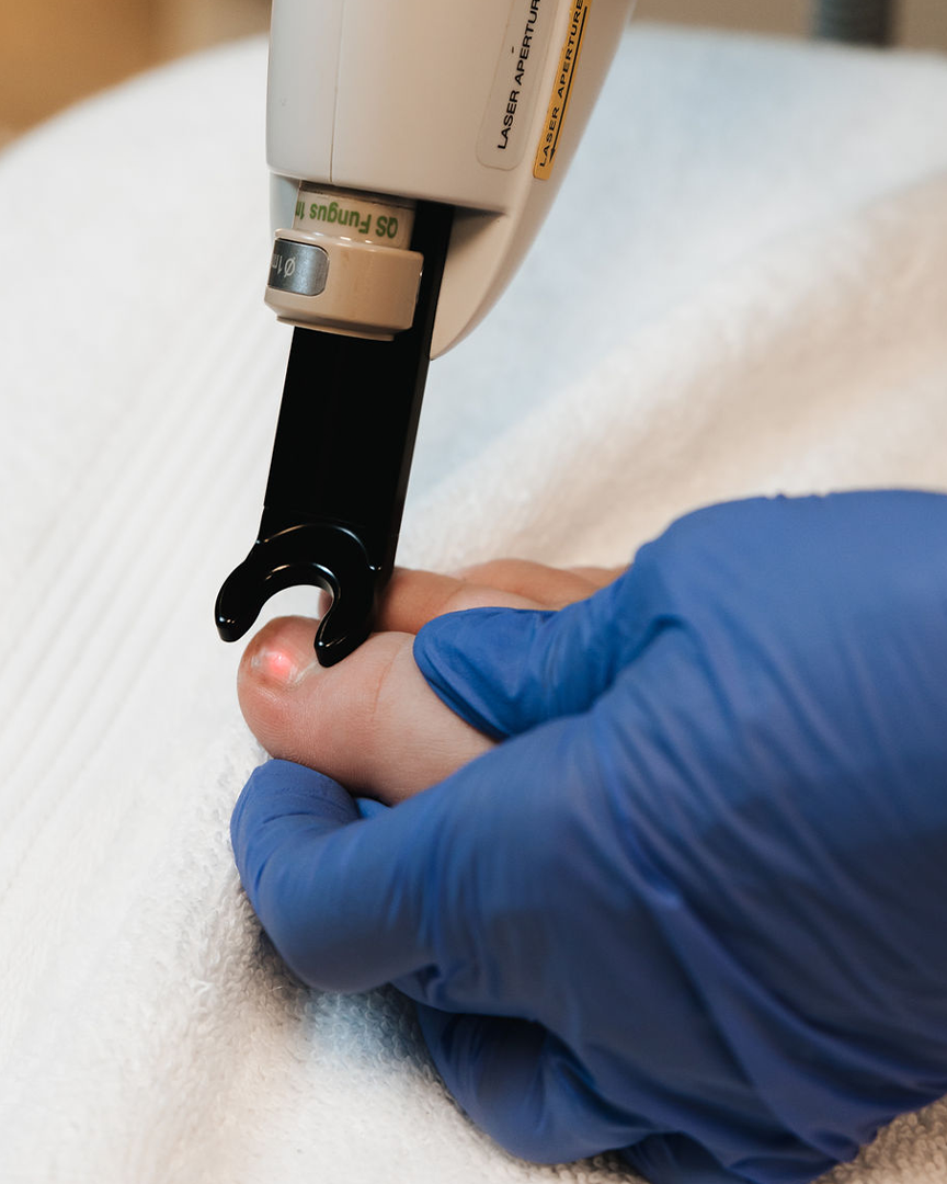 Mjög nær mynd af laser sem beitt er á tánögl til að fjarlægja svepp. Hjúkrunarfræðingur heldur varlega um fót sjúklings á meðan háþróuð tækni vinnur á sveppnum. Húðfegrun notar öruggar, klínískar lausnir. Bókaðu tíma í dag.