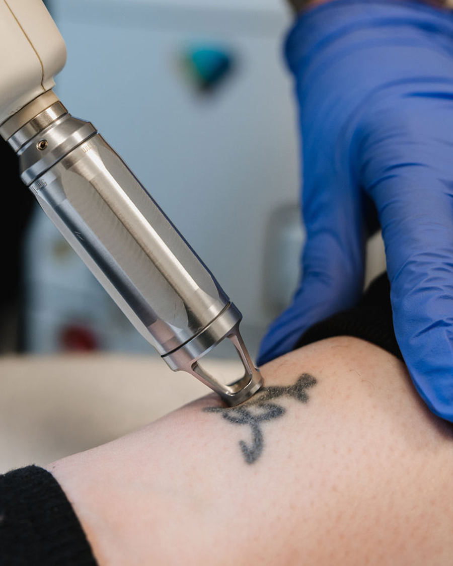 Nærmynd af viðskiptavini hjá Húðfegrun í Reykjavík sem fær tattoo fjarlægt með lasermeðferð. Hjúkrunarfræðingur framkvæmir meðferðina með nýjustu tækni sem tryggir öruggan og árangursríkan árangur. Bókaðu tíma í dag.