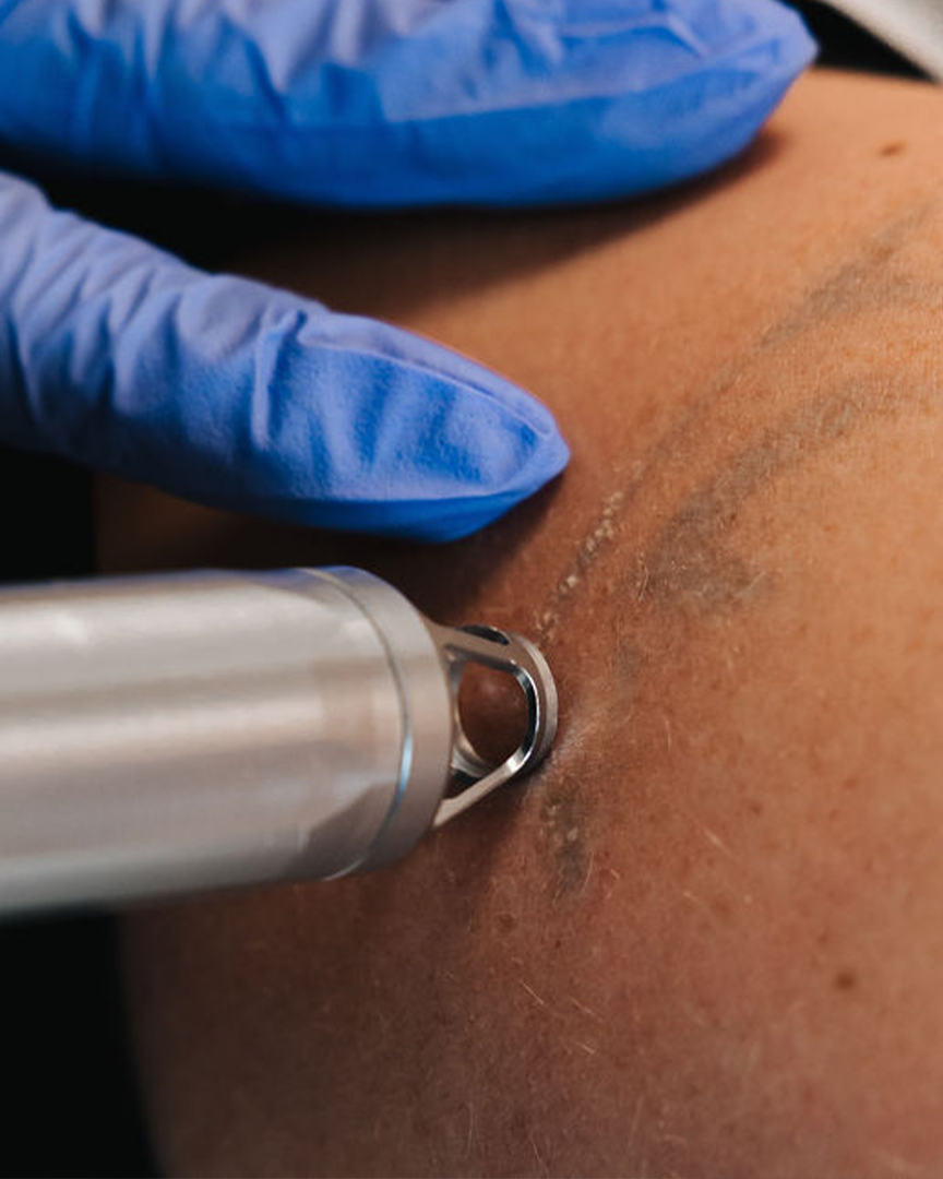 Mjög nær mynd af laser­tæki í notkun við tattooeyðingu. Húðfegrun notar háþróaða tækni sem brýtur niður litarefni í húð án skemmda á nærliggjandi vef. Örugg meðferð hjá sérfræðingum í Reykjavík – bókaðu faglega þjónustu.