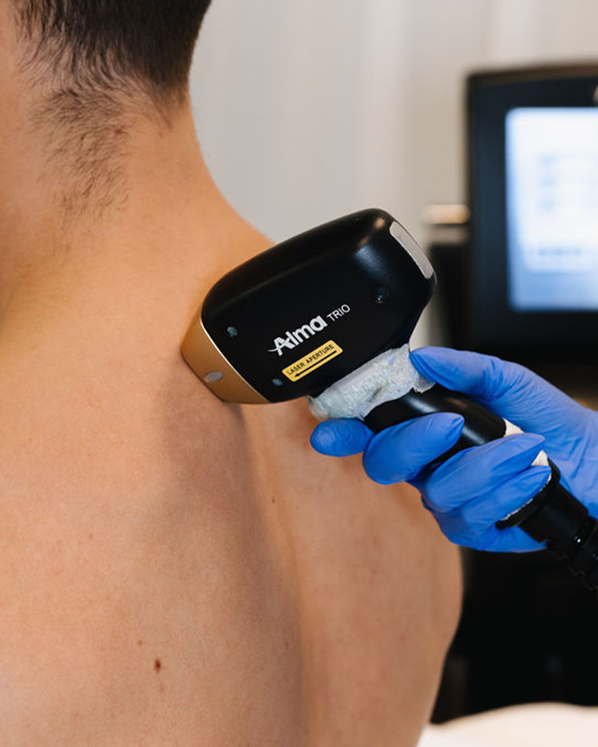Hjúkrunarfræðingur hjá Húðfegrun framkvæmir laser háreyðingu á baki. Meðferðin er örugg, árangursrík og hentar vel fyrir karla sem vilja fjarlægja óæskilegan hárvöxt. Bókaðu faglega meðferð á húðklíníku í Reykjavík.
