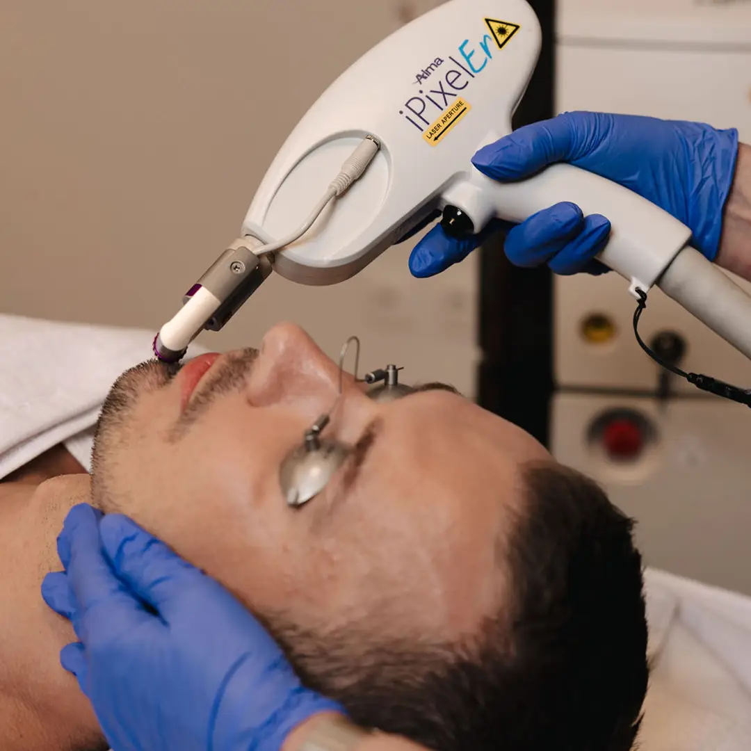 Hjúkrunarfræðingur hjá Húðfegrun framkvæmir Erbium YAG Laser á karlmanni í afslöppuðu og faglegu klínísku umhverfi. Meðferðin þéttir húð, vinnur á línum og gefur jafnan húðlit. Bókaðu tíma hjá sérfræðingum okkar í Reykjavík.