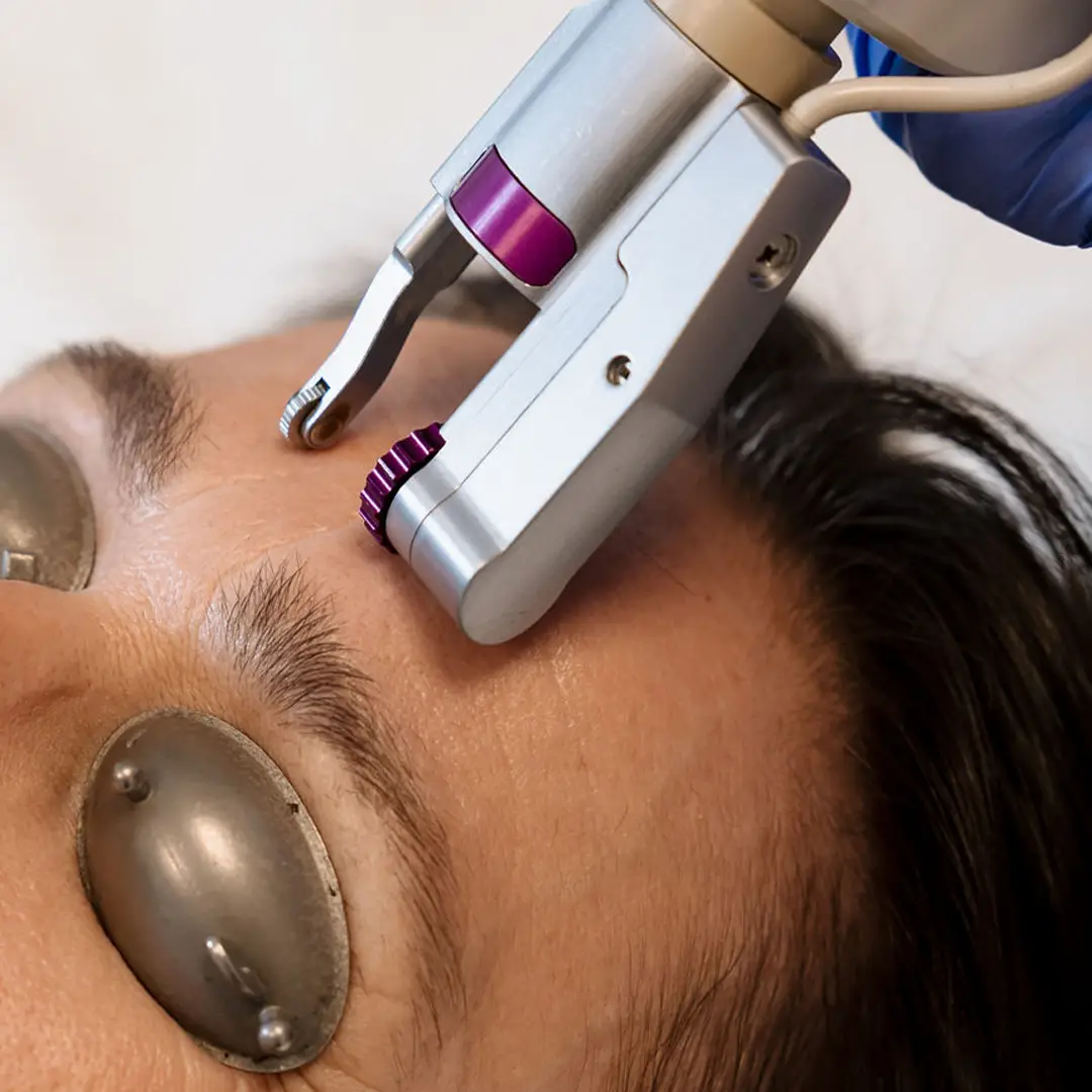 Nærmynd af enni þar sem hjúkrunarfræðingur hjá Húðfegrun framkvæmir Erbium YAG Laser meðferð. Öflug lasermeðferð sem endurnýjar húð og jafnar áferð á öruggan hátt. Bókaðu meðferð á klínísku húðstofunni í Reykjavík.