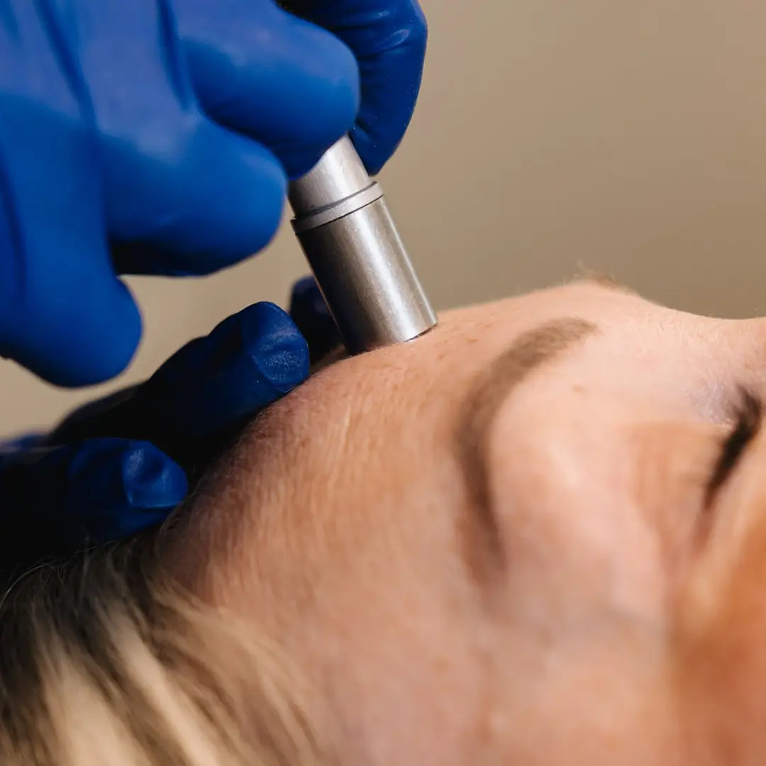 Nærmynd af pönnu í húðslípun hjá Húðfegrun. Húðin endurnýjast samstundis og fær bjartara yfirbragð. Meðferðin er framkvæmd af hjúkrunarfræðingi með nýjustu tækni. Bókaðu meðferð í klínísku umhverfi í Reykjavík.