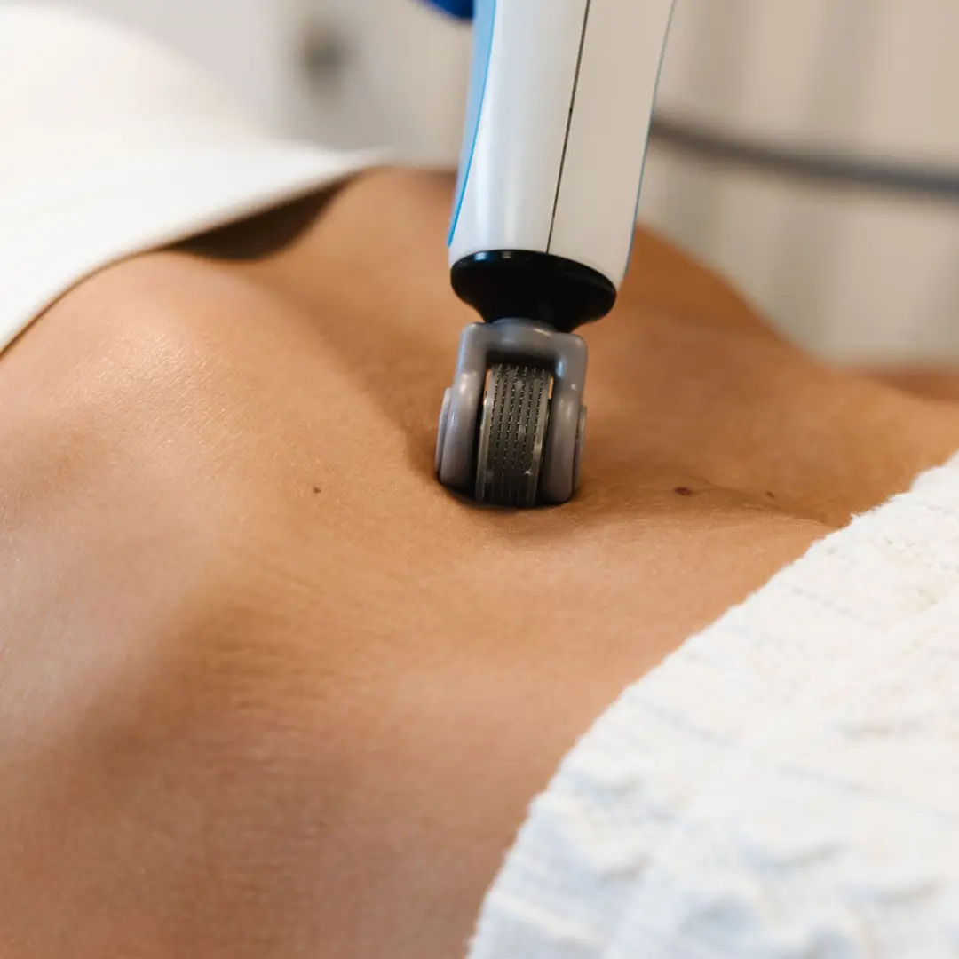 RF microplasma meðferð sem vinnur á örum og húðslitum, jafnar áferð og bætir teygjanleika húðarinnar.