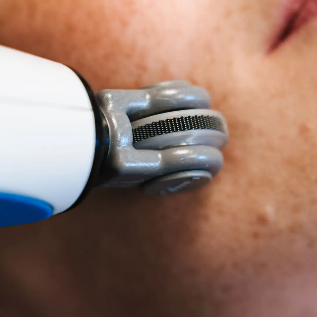 Nærmynd af andliti í lasermeðferð hjá Húðfegrun. Tæknin vinnur á örum, litabreytingum og ójöfnum húðar á öruggan hátt. Framkvæmt af hjúkrunarfræðingum með nýjustu búnaði í Reykjavík. Bókaðu tíma í dag.