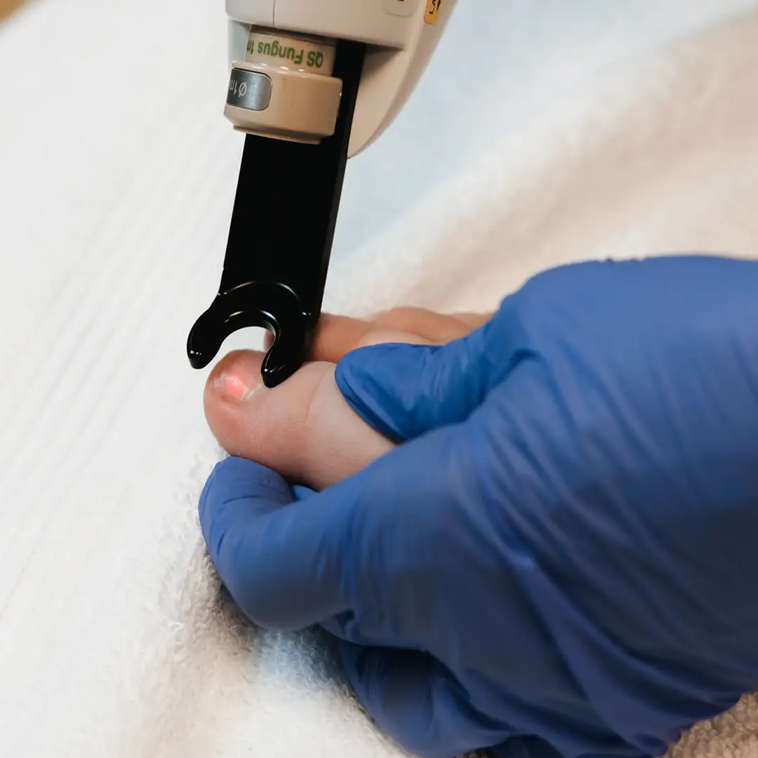 Mjög nær mynd af laser sem beitt er á tánögl til að fjarlægja svepp. Hjúkrunarfræðingur heldur varlega um fót sjúklings á meðan háþróuð tækni vinnur á sveppnum. Húðfegrun notar öruggar, klínískar lausnir. Bókaðu tíma í dag.