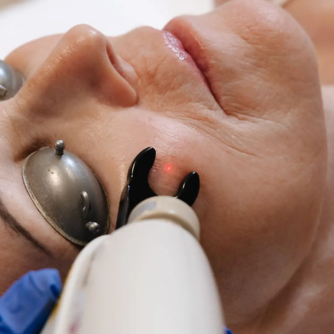 Mjög nær mynd af laser­tæki notuðu við meðferð gegn háræðaslitum og rósroða. Húðfegrun notar háþróaða tækni til að minnka roða og jafna húðlit á öruggan hátt. Bókaðu faglega meðferð í Reykjavík.