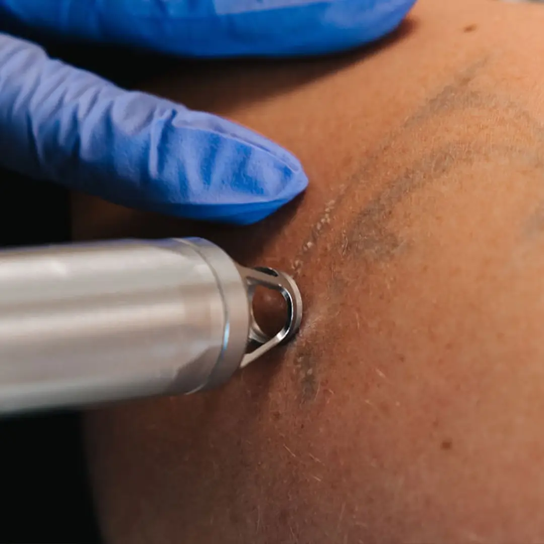 Mjög nær mynd af laser­tæki í notkun við tattooeyðingu. Húðfegrun notar háþróaða tækni sem brýtur niður litarefni í húð án skemmda á nærliggjandi vef. Örugg meðferð hjá sérfræðingum í Reykjavík – bókaðu faglega þjónustu.