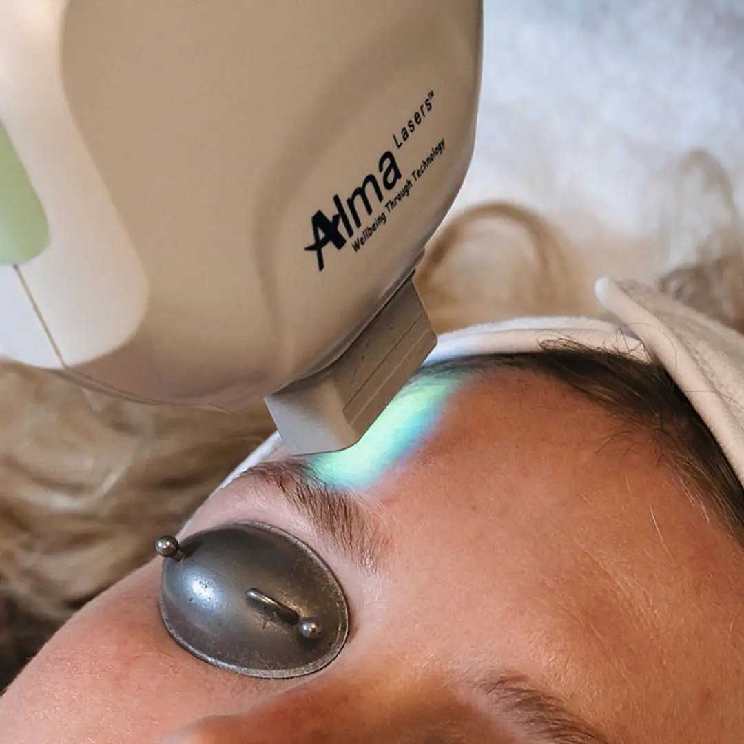 Mjög nær mynd af ALMA laser í notkun við litabreytingar í húð. Meðferðin vinnur á sólarskemmdum og brúnum blettum án skemmda á húð. Húðfegrun notar nýjustu lasermeðferðartækni á Íslandi. Bókaðu faglega meðferð í Reykjavík.