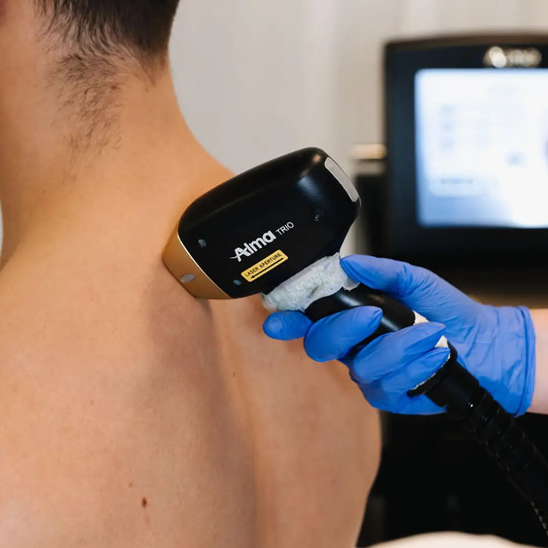 Hjúkrunarfræðingur hjá Húðfegrun framkvæmir laser háreyðingu á baki. Meðferðin er örugg, árangursrík og hentar vel fyrir karla sem vilja fjarlægja óæskilegan hárvöxt. Bókaðu faglega meðferð á húðklíníku í Reykjavík.