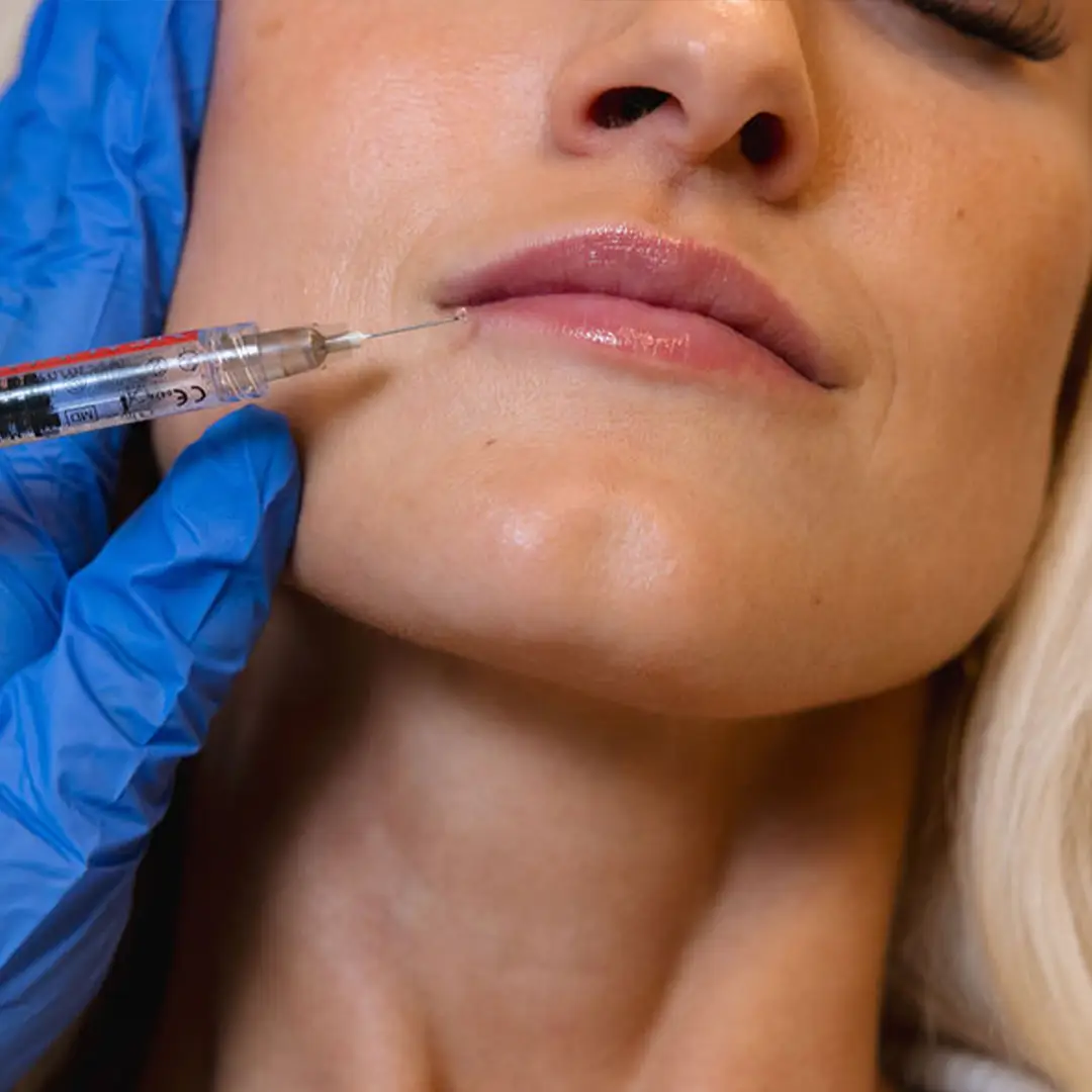 Hjúkrunarfræðingur sprautar náttúrulegu fylliefni til að endurheimta fyllingu, móta andlit og draga úr hrukkum á öruggan hátt.