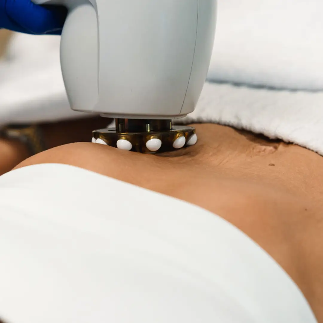 Hjúkrunarfræðingur hjá Húðfegrun framkvæmir Skin Tightening á maga með háþróaðri laser- og RF-tækni. Meðferð sem styður áhrif Hyaluronic Acid Booster. Fáðu stinnari húð – bókaðu meðferð í klínísku umhverfi Húðfegrunar.